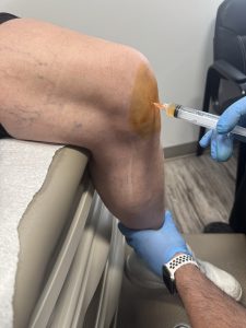 PRP knee injection